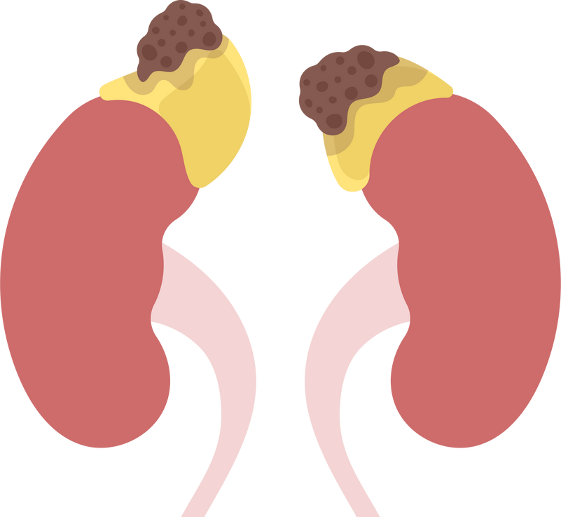 Disorder Adrenal Gland