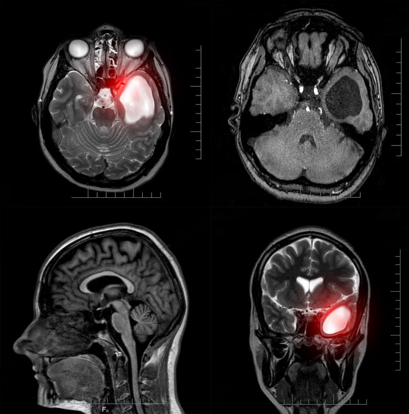 Magnetic Resonance Imaging of a Patient with a Temporal Horn Cyst of the Left Lateral Ventricle of the Brain. Atrophic Changes in the Temporal Lobe. Causes of Headaches. Arachnoid Cyst